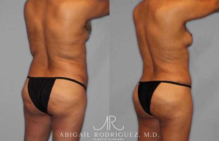 Before & After Fat Grafting Case 257521 View 7 View in Houston, TX