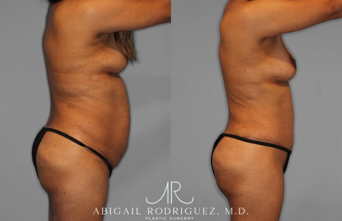 Before & After Fat Grafting Case 257521 View 8 View in Houston, TX