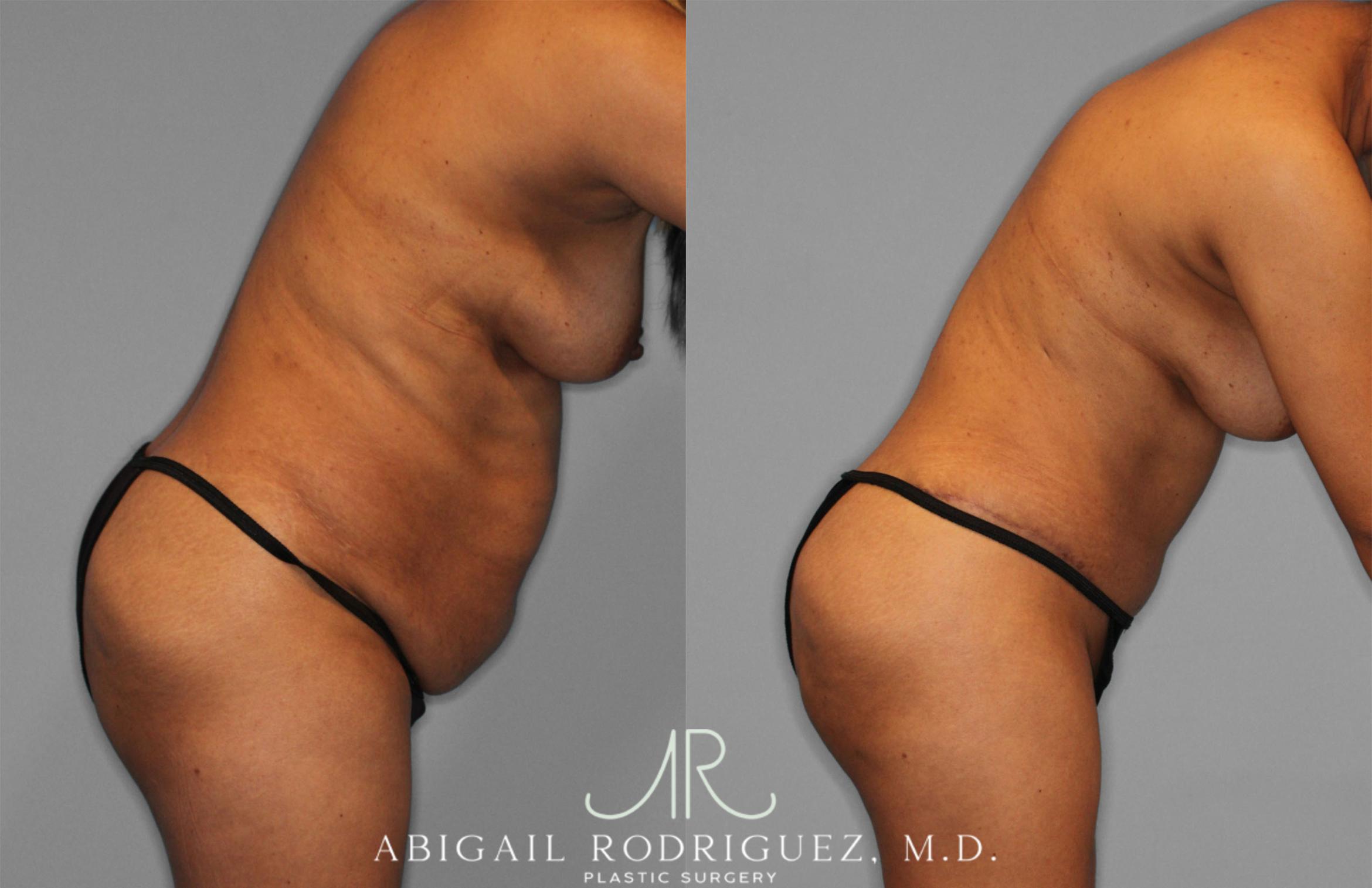 Before & After Fat Grafting Case 257521 View 9 View in Houston, TX