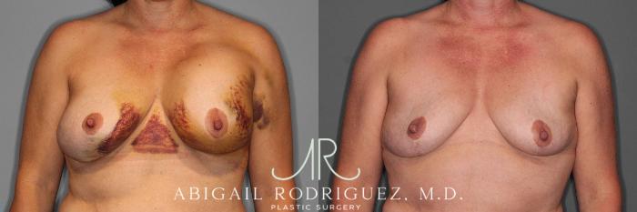 Before & After Implant Removal Case 254570 View 1 View in Houston, TX