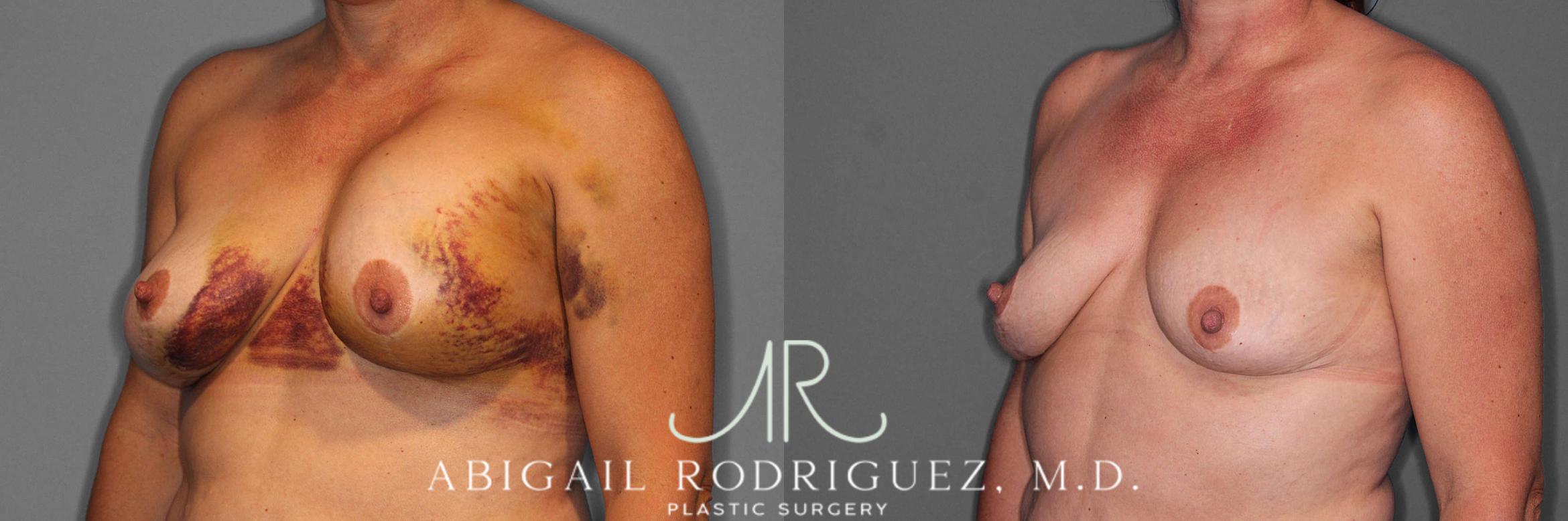 Before & After Implant Removal Case 254570 View 2 View in Houston, TX