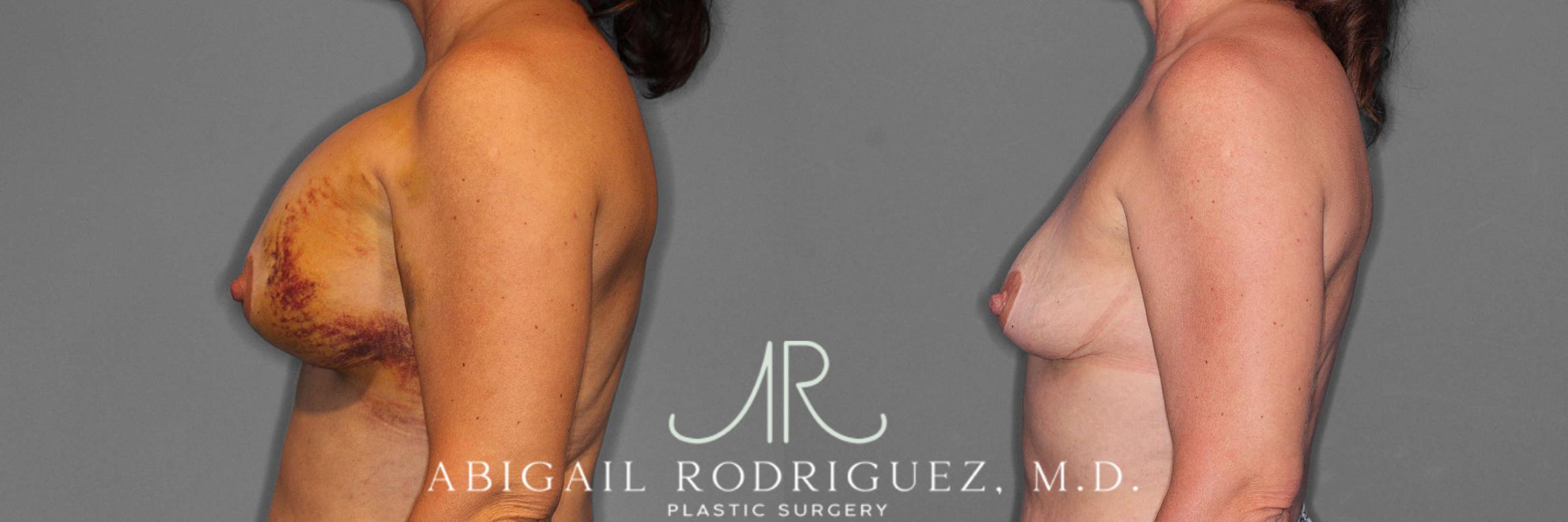 Before & After Implant Removal Case 254570 View 3 View in Houston, TX