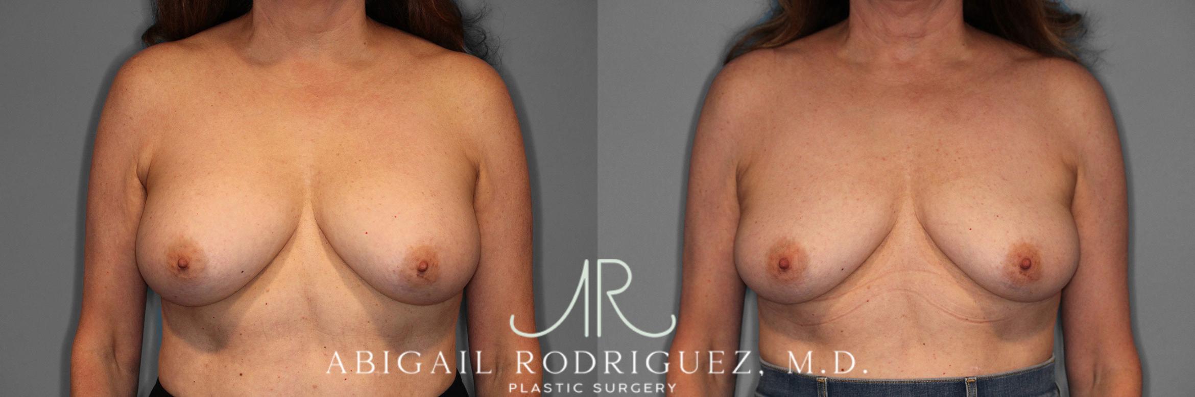 Before & After Implant Removal Case 258169 View 1 View in Houston, TX