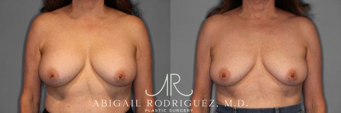 Before & After Implant Removal Case 258169 View 1 View in Houston, TX
