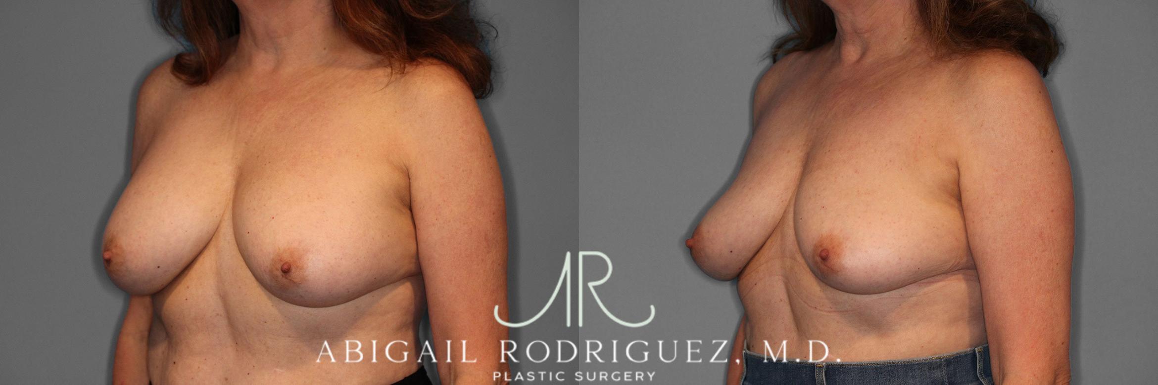 Before & After Implant Removal Case 258169 View 3 View in Houston, TX