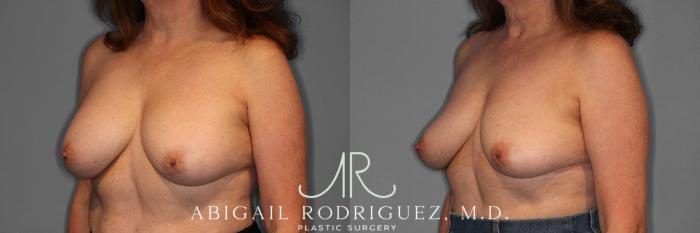 Before & After Implant Removal Case 258169 View 3 View in Houston, TX