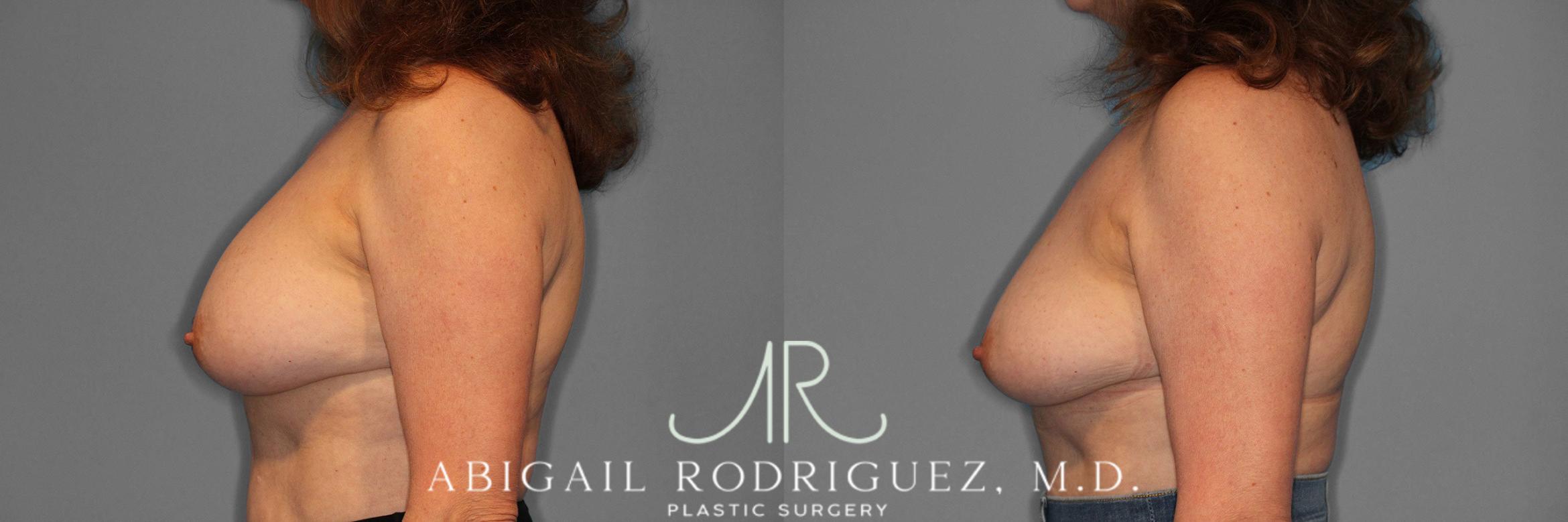 Before & After Implant Removal Case 258169 View 4 View in Houston, TX