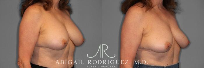 Before & After Implant Removal Case 258169 View 5 View in Houston, TX