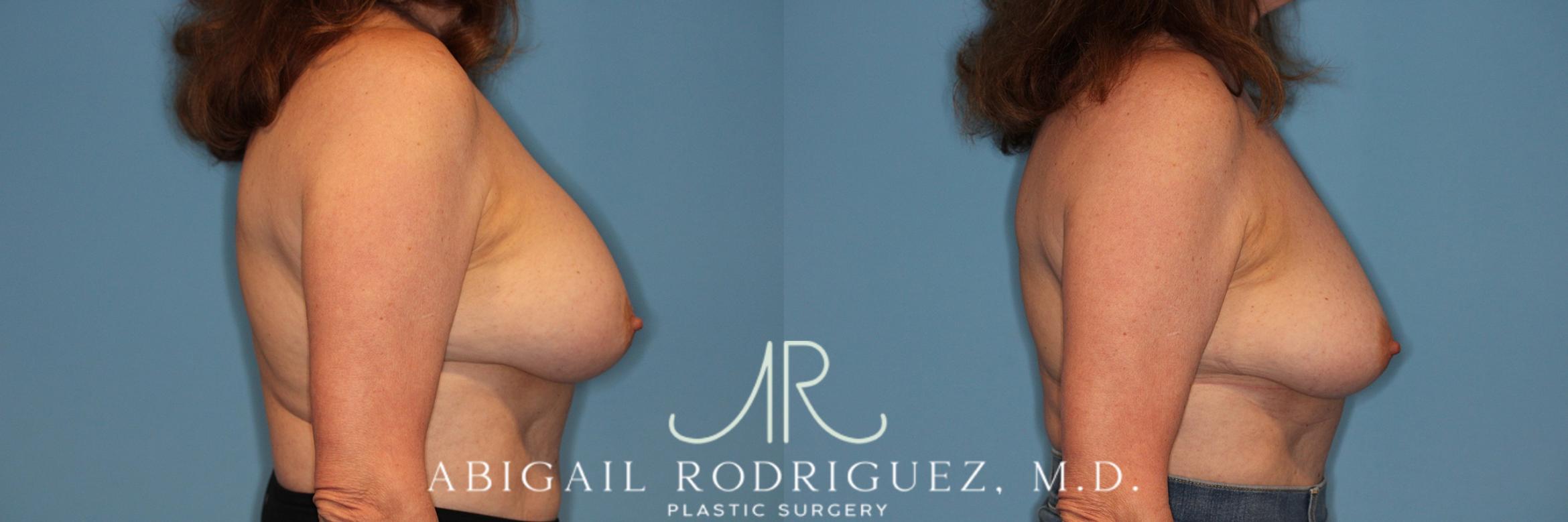 Before & After Implant Removal Case 258169 View 6 View in Houston, TX
