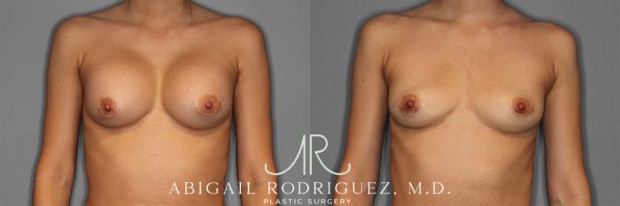 Before & After Implant Removal Case 258641 View 1 View in Houston, TX