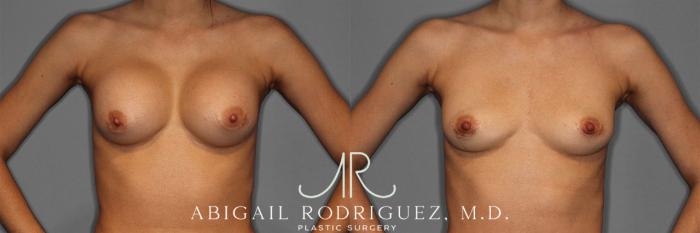 Before & After Implant Removal Case 258641 View 2 View in Houston, TX