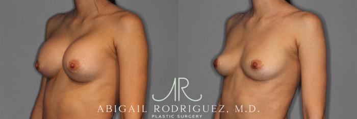 Before & After Implant Removal Case 258641 View 3 View in Houston, TX