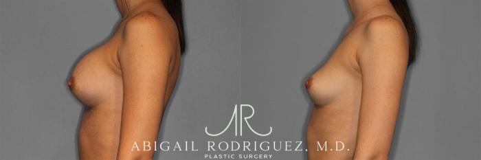 Before & After Implant Removal Case 258641 View 4 View in Houston, TX