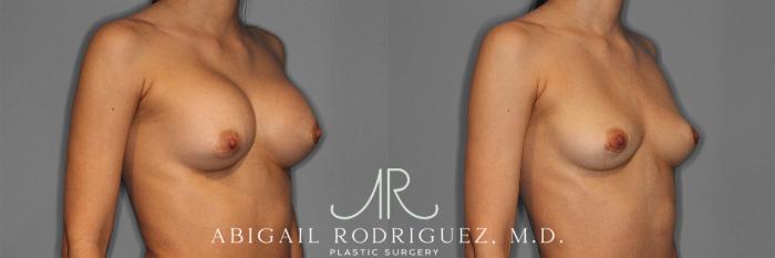 Before & After Implant Removal Case 258641 View 5 View in Houston, TX