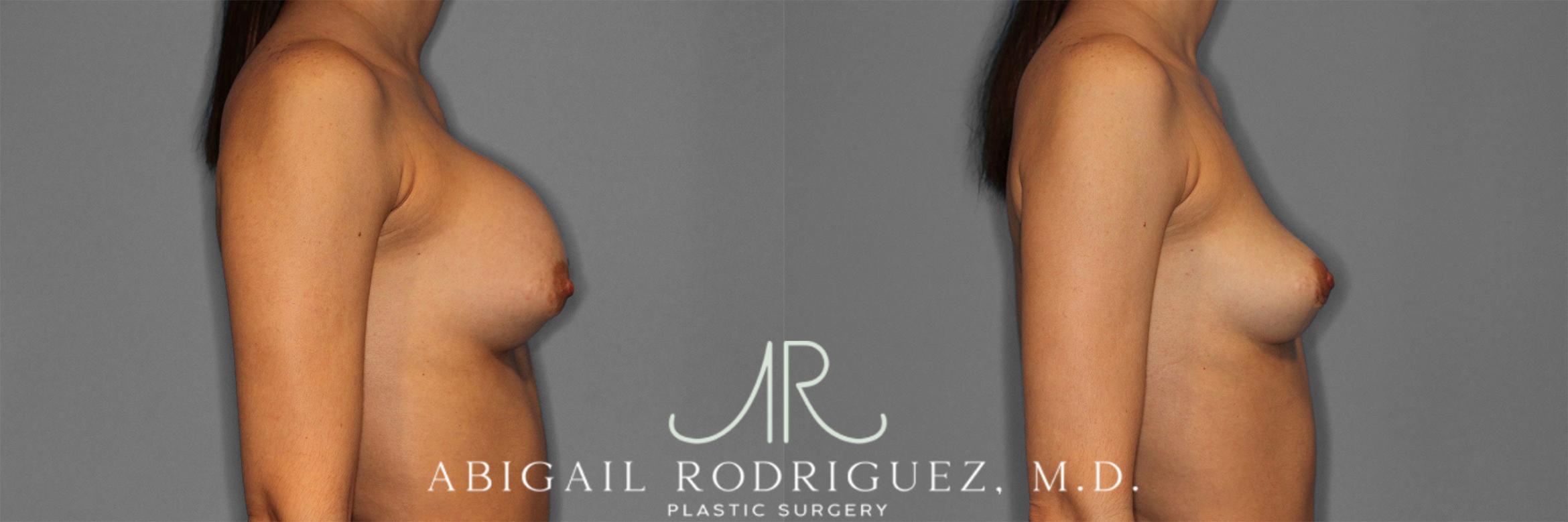 Before & After Implant Removal Case 258641 View 6 View in Houston, TX