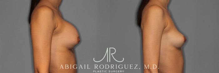 Before & After Implant Removal Case 258641 View 6 View in Houston, TX