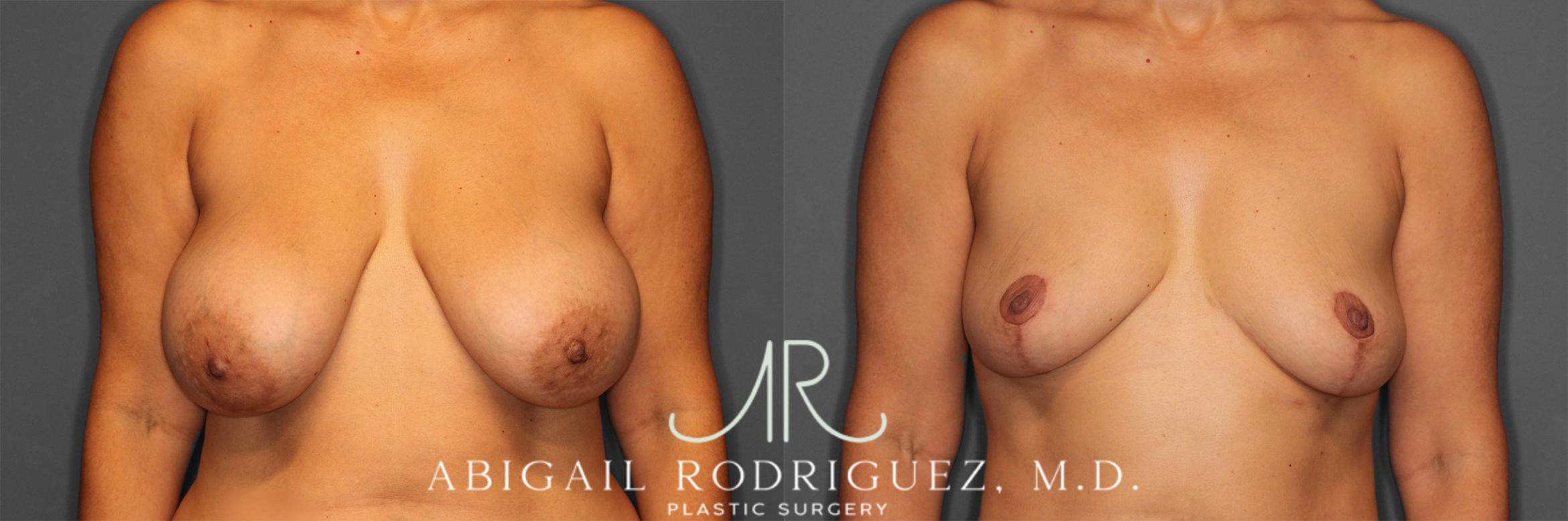 Before & After Implant Removal and Lift Case 258839 View 1 View in Houston, TX