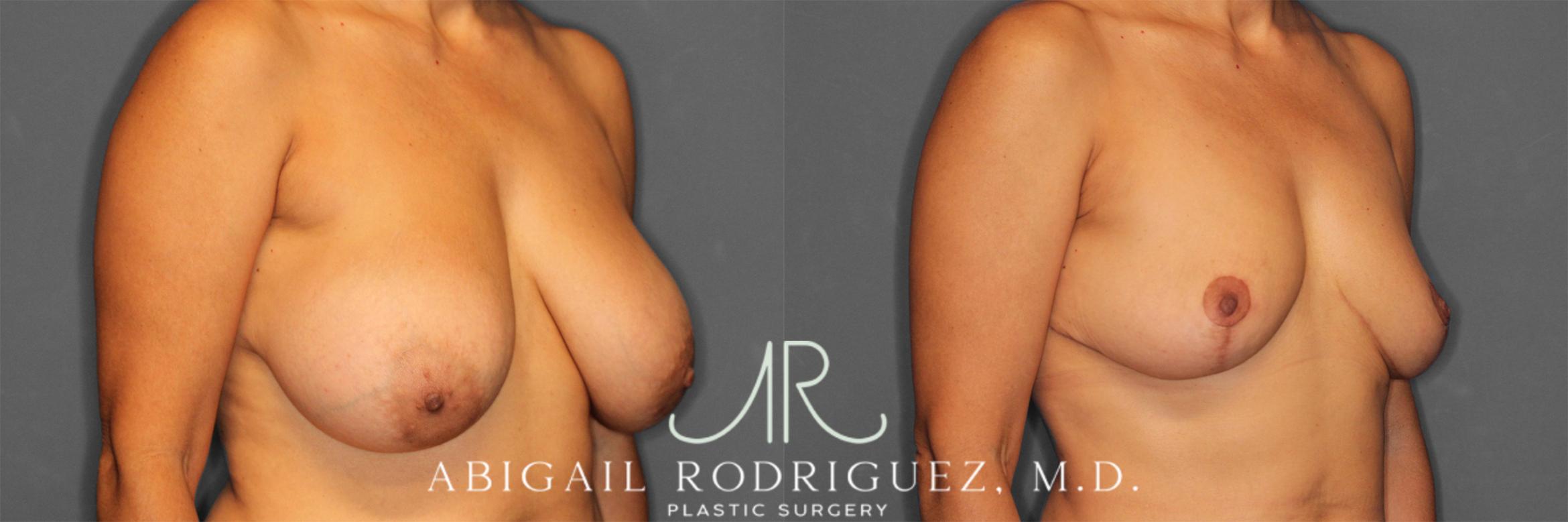 Before & After Implant Removal and Lift Case 258839 View 2 View in Houston, TX