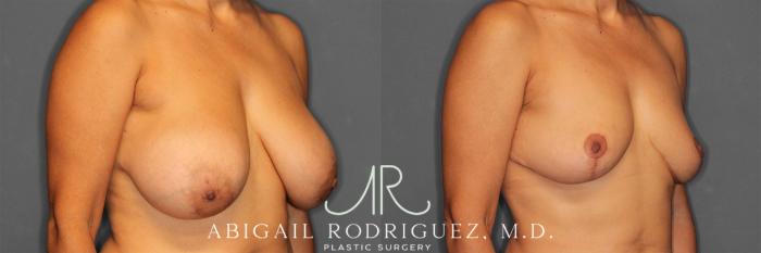 Before & After Implant Removal and Lift Case 258839 View 2 View in Houston, TX