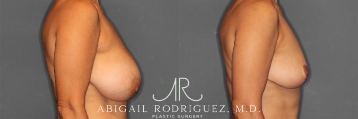 Before & After Implant Removal and Lift Case 258839 View 3 View in Houston, TX