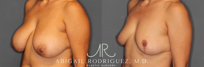 Before & After Implant Removal and Lift Case 258839 View 4 View in Houston, TX