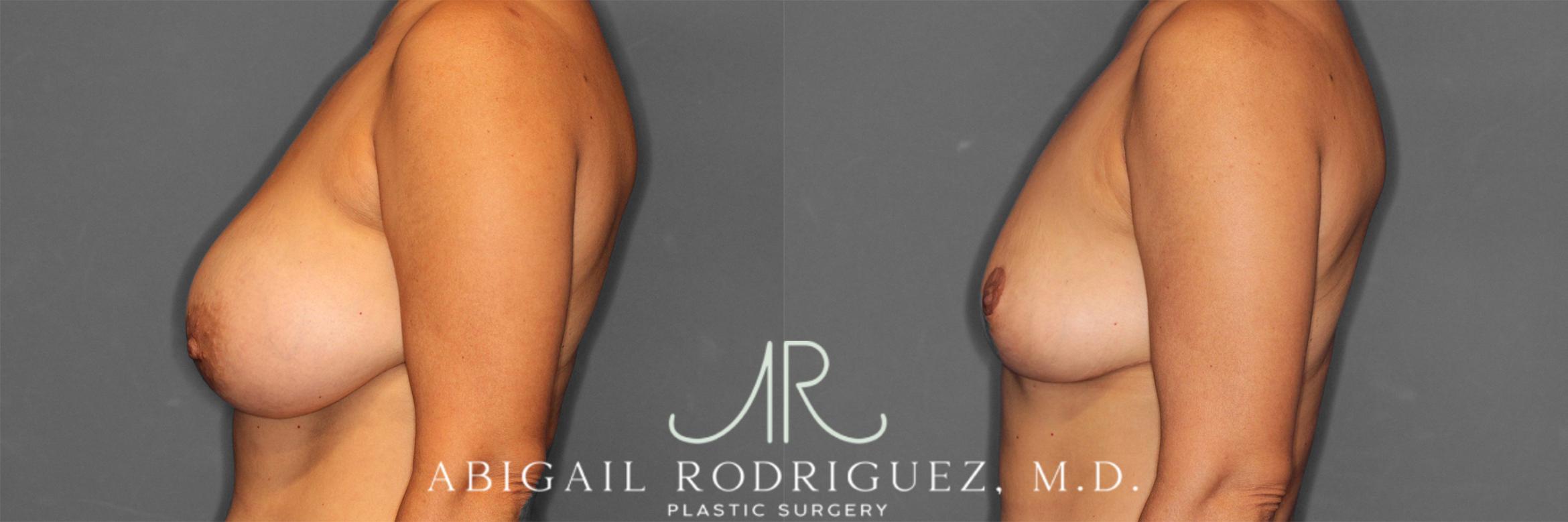 Before & After Implant Removal and Lift Case 258839 View 5 View in Houston, TX