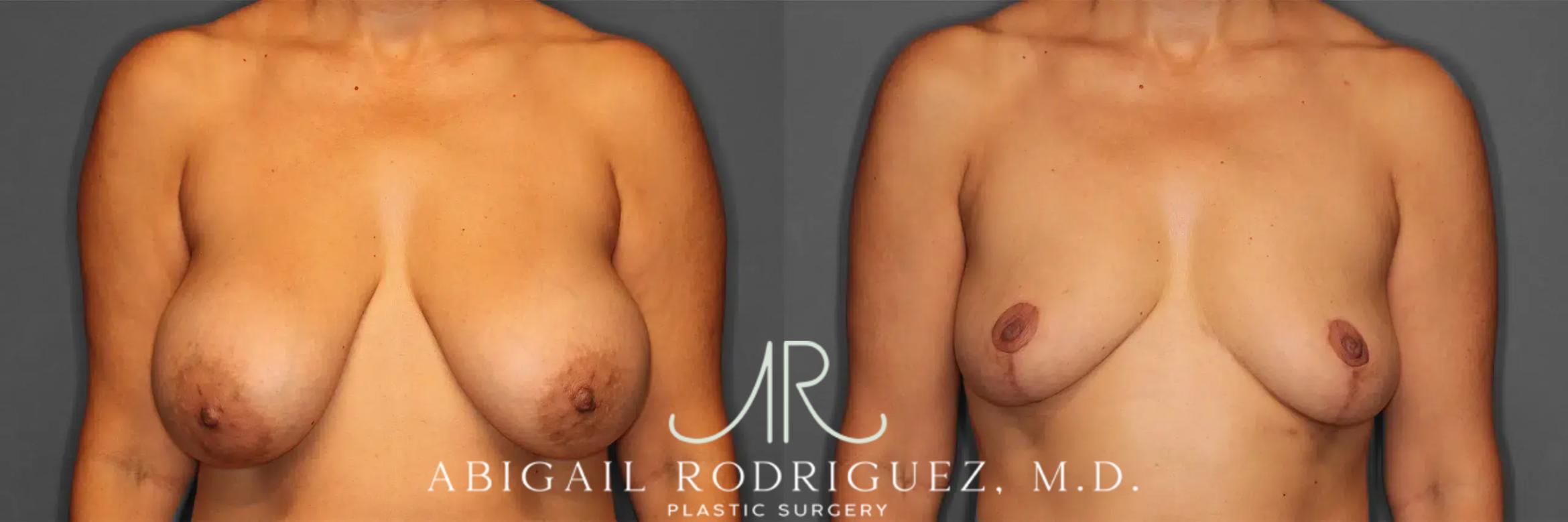 Before & After Implant Removal and Lift Case 259215 View 1 View in Houston, TX