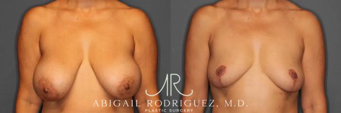 Before & After Implant Removal and Lift Case 259215 View 1 View in Houston, TX