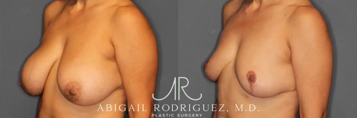 Before & After Implant Removal and Lift Case 259215 View 2 View in Houston, TX