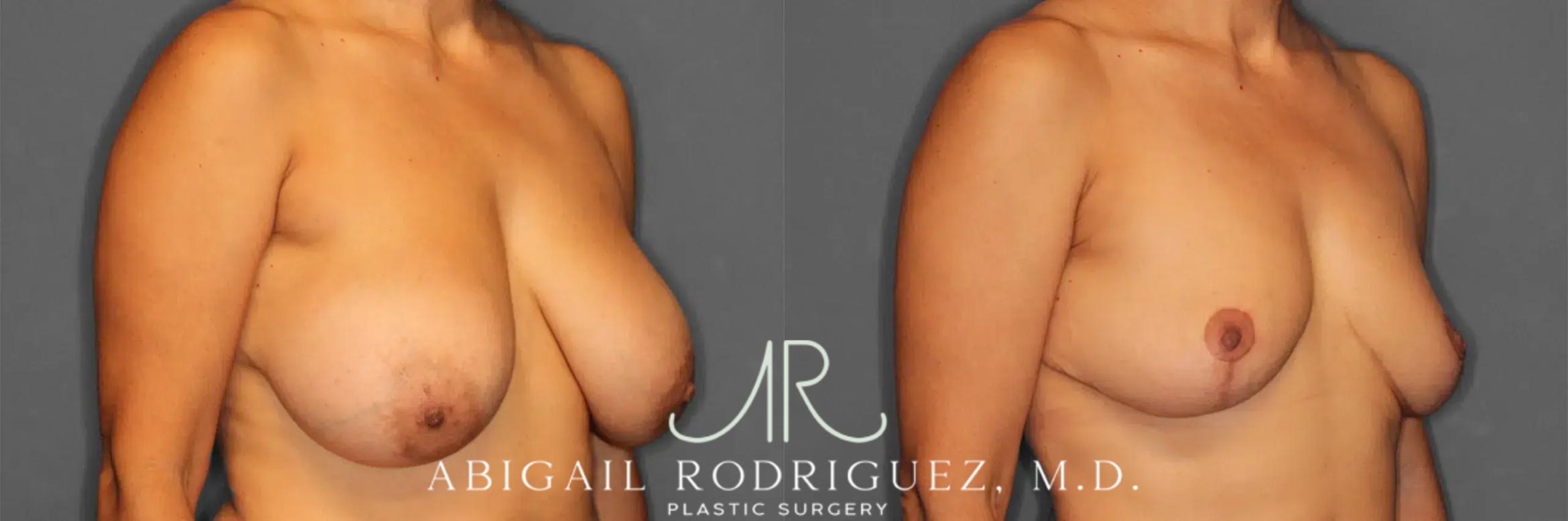 Before & After Implant Removal and Lift Case 259215 View 3 View in Houston, TX