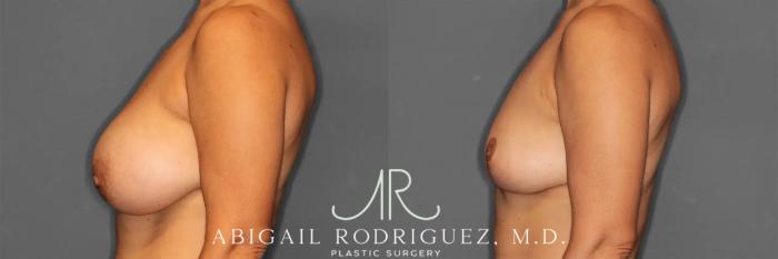 Before & After Implant Removal and Lift Case 259215 View 4 View in Houston, TX