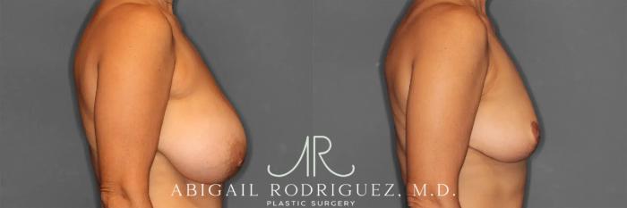 Before & After Implant Removal and Lift Case 259215 View 5 View in Houston, TX