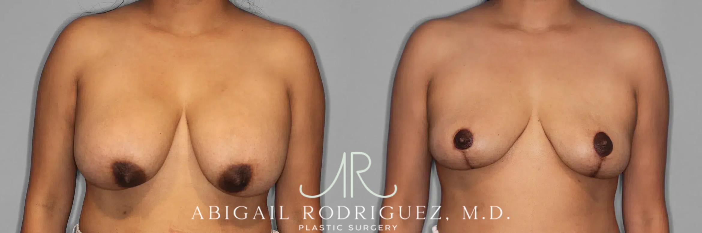 Before & After Implant Removal and Lift Case 259474 View 1 View in Houston, TX