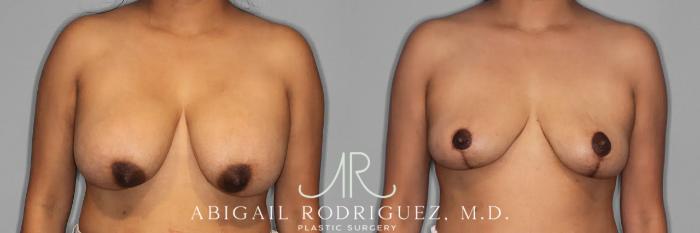 Before & After Implant Removal and Lift Case 259474 View 1 View in Houston, TX