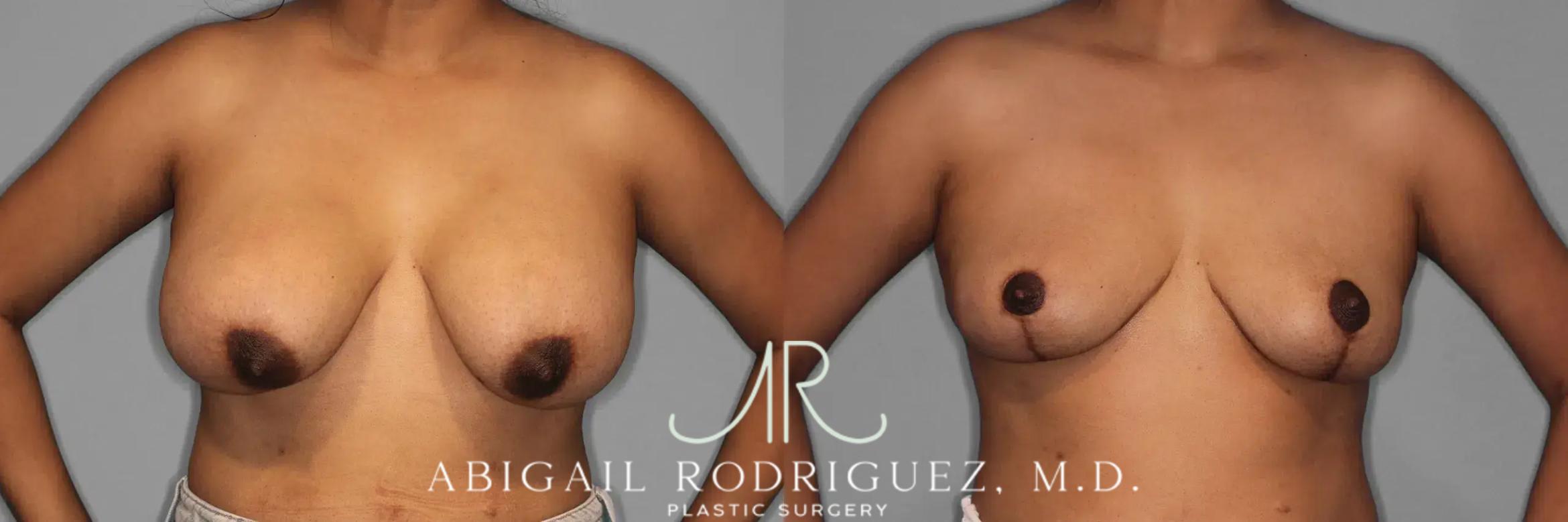 Before & After Implant Removal and Lift Case 259474 View 2 View in Houston, TX