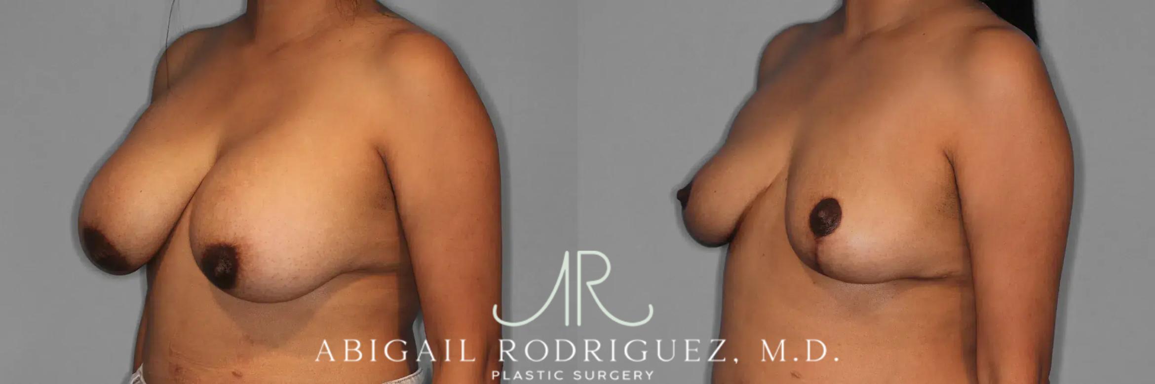 Before & After Implant Removal and Lift Case 259474 View 3 View in Houston, TX