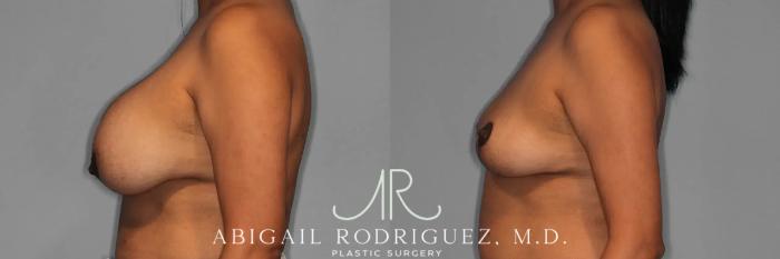 Before & After Implant Removal and Lift Case 259474 View 4 View in Houston, TX