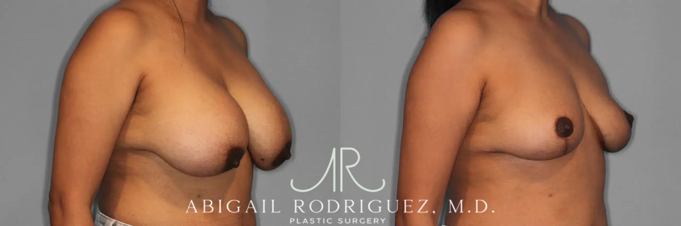 Before & After Implant Removal and Lift Case 259474 View 5 View in Houston, TX