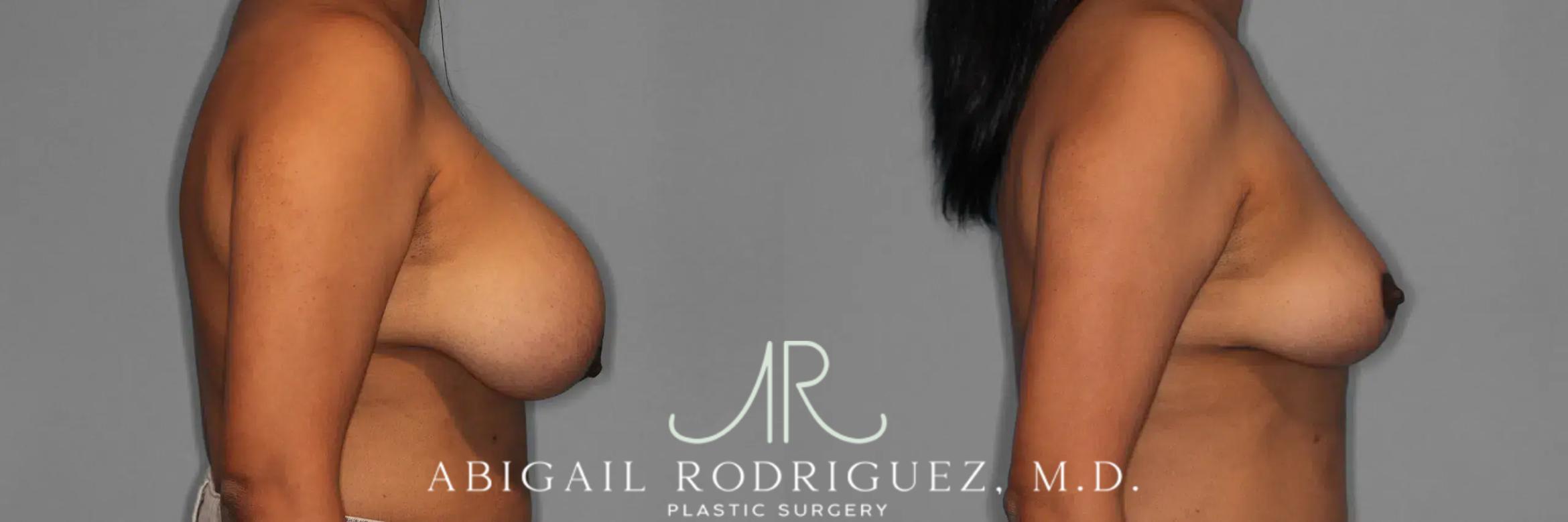 Before & After Implant Removal and Lift Case 259474 View 6 View in Houston, TX