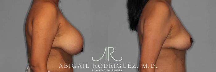 Before & After Implant Removal and Lift Case 259474 View 6 View in Houston, TX