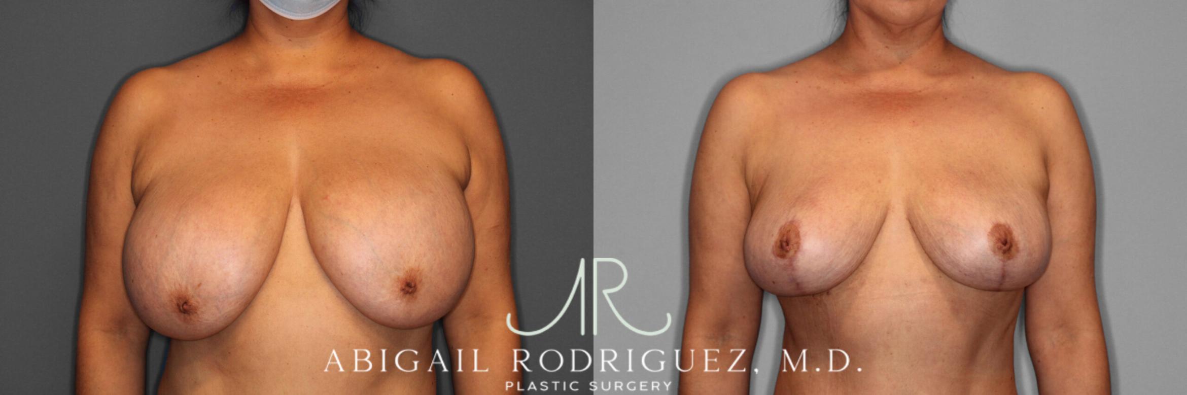 Before & After Implant Removal and Lift Case 74332 View 1 View in Houston, TX