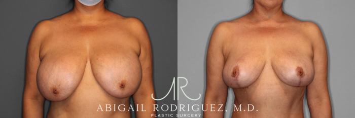 Before & After Implant Removal and Lift Case 74332 View 1 View in Houston, TX