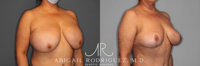 Before & After Implant Removal and Lift Case 74332 View 2 View in Houston, TX