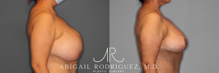Before & After Implant Removal and Lift Case 74332 View 3 View in Houston, TX