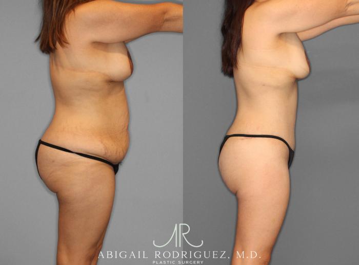 Before & After Liposuction Case 153243 View 3 View in Houston, TX