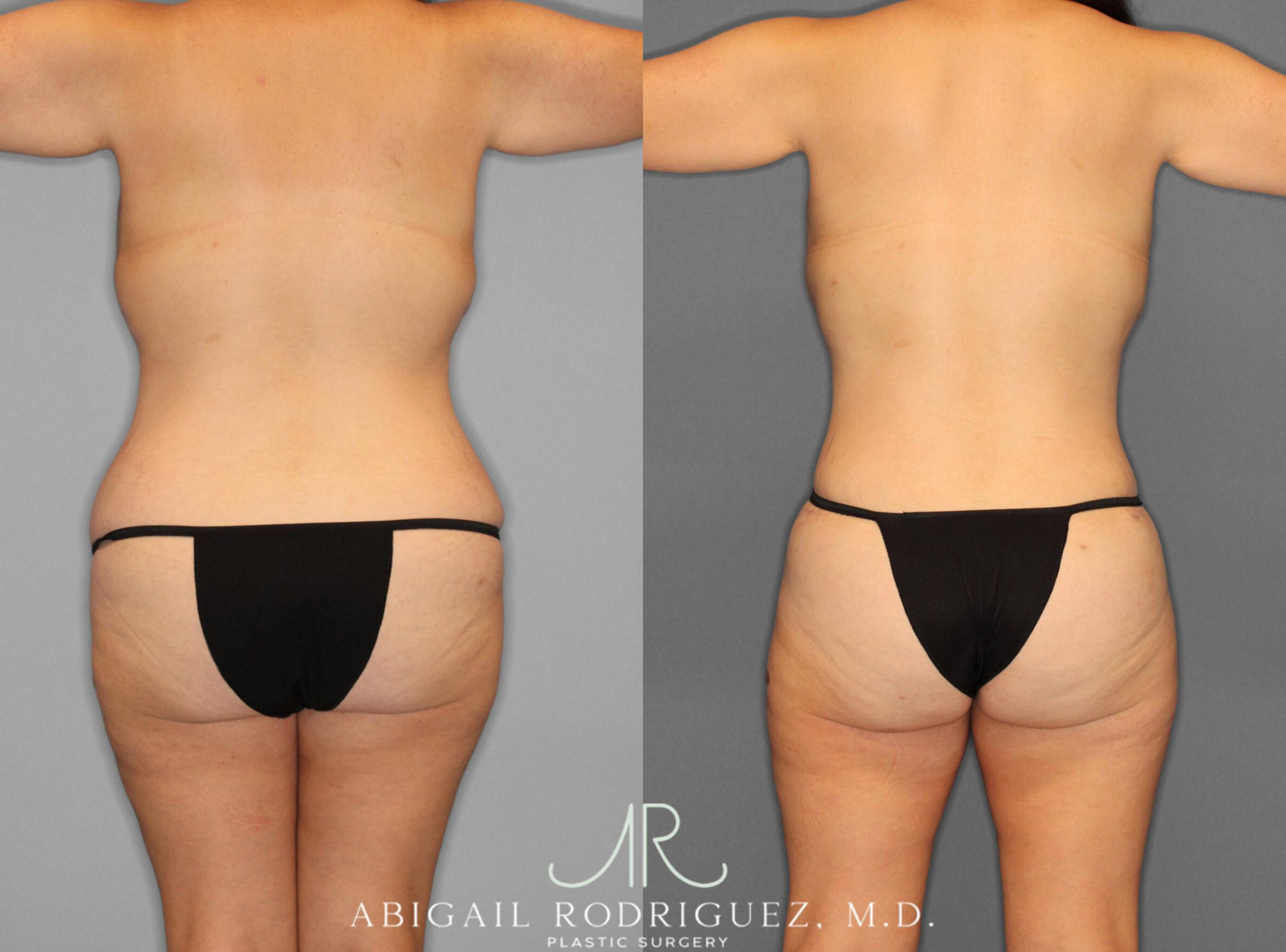 Before & After Liposuction Case 153243 View 5 View in Houston, TX
