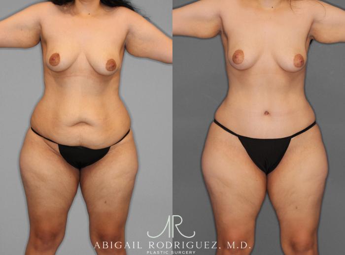 Before & After Tummy Tuck Case 253950 View 1 View in Houston, TX