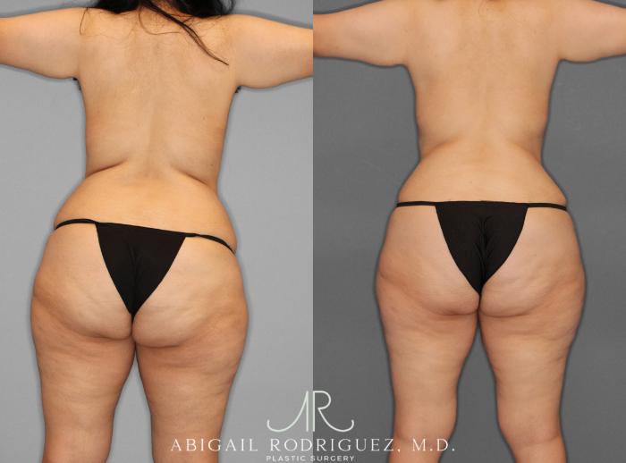 Before & After Liposuction Case 253950 View 5 View in Houston, TX