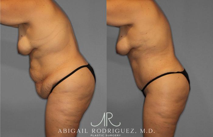 Before & After Liposuction Case 254838 View 4 View in Houston, TX