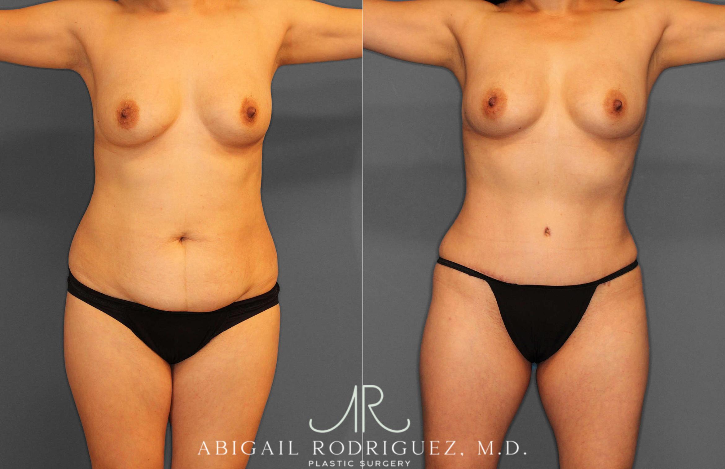 Before & After Liposuction Case 254862 View 1 View in Houston, TX